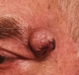 Le neoplasie palpebrali