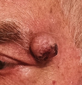 Le neoplasie palpebrali